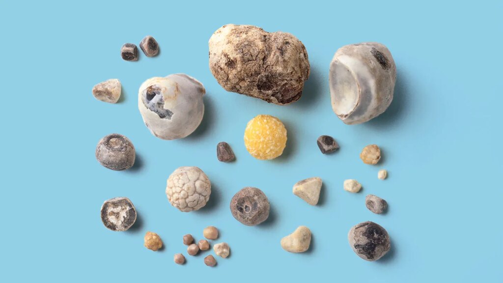 Crohn’s Complications: What to Know About Gallstones