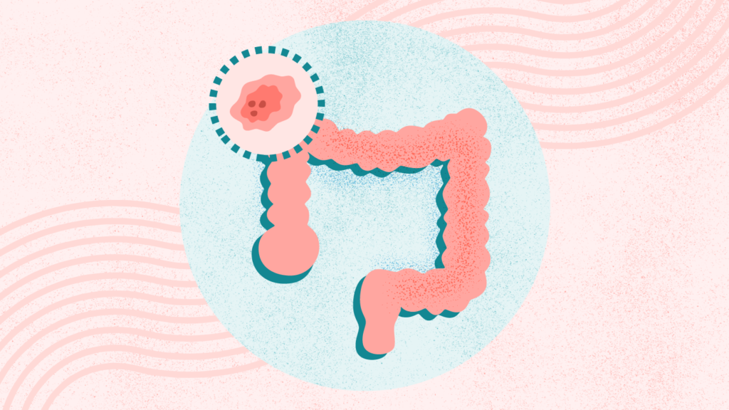 What Is Colon and Rectal Cancer? Symptoms, Causes, Diagnosis, Treatment, and Prevention