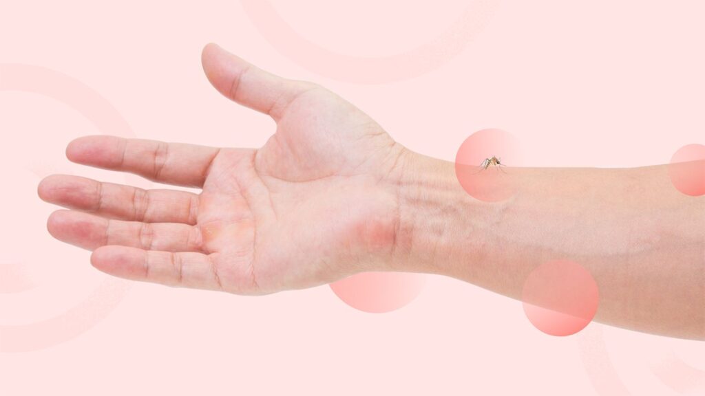 Are You a Mosquito Magnet? Here’s Why and What to Do About It Are You a Mosquito Magnet? Here’s Why and What to Do About It