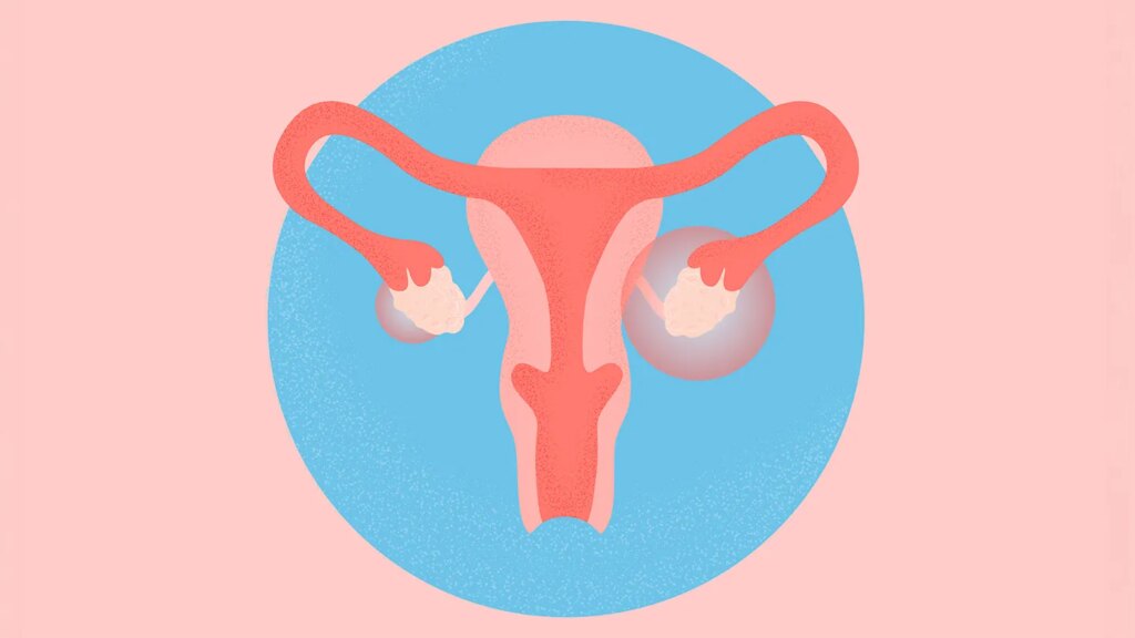 What Is Polyendocrine Metabolic Ovarian Syndrome (PMOS), Formerly Known as PCOS? Symptoms, Causes, Diagnosis, and Treatment What Is Polyendocrine Metabolic Ovarian Syndrome (PMOS), Formerly Known as PCOS?