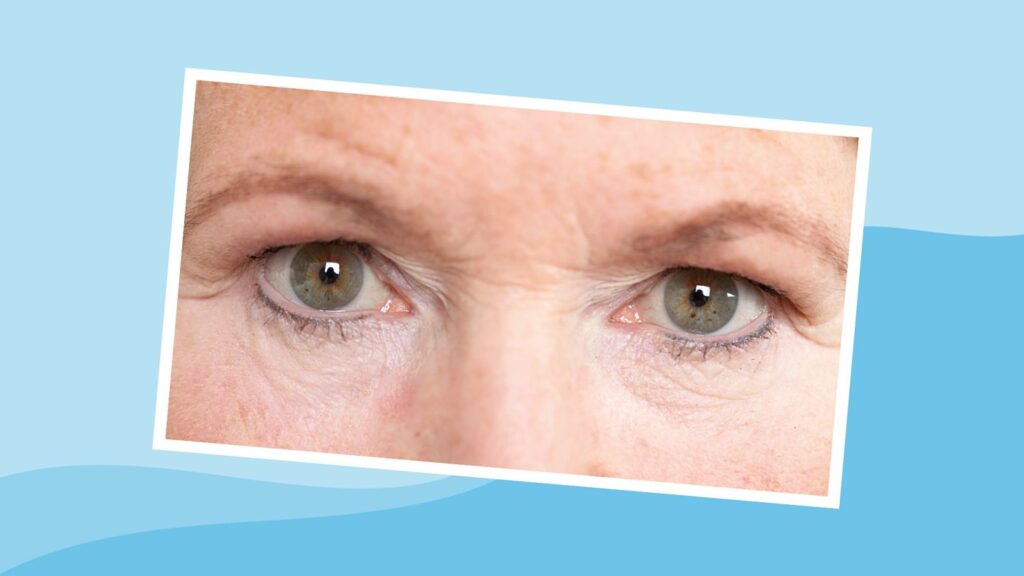 Why It Happens, What You Can Do About It Why Your Eyelids Get Droopy as You Age and What You Can Do About It