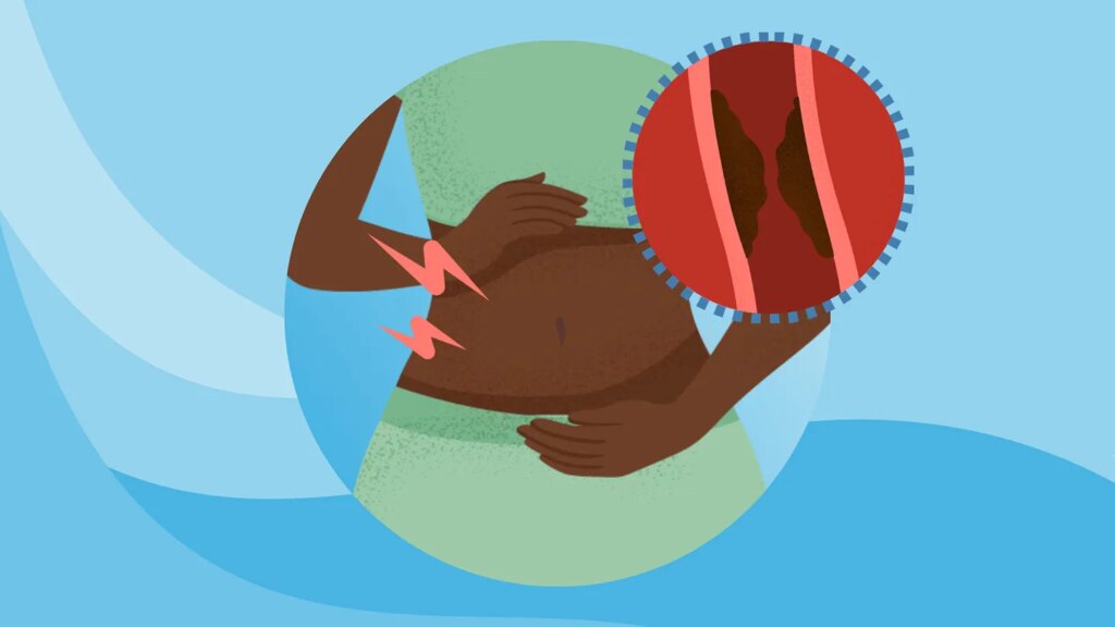 What Is Fecal Impaction?